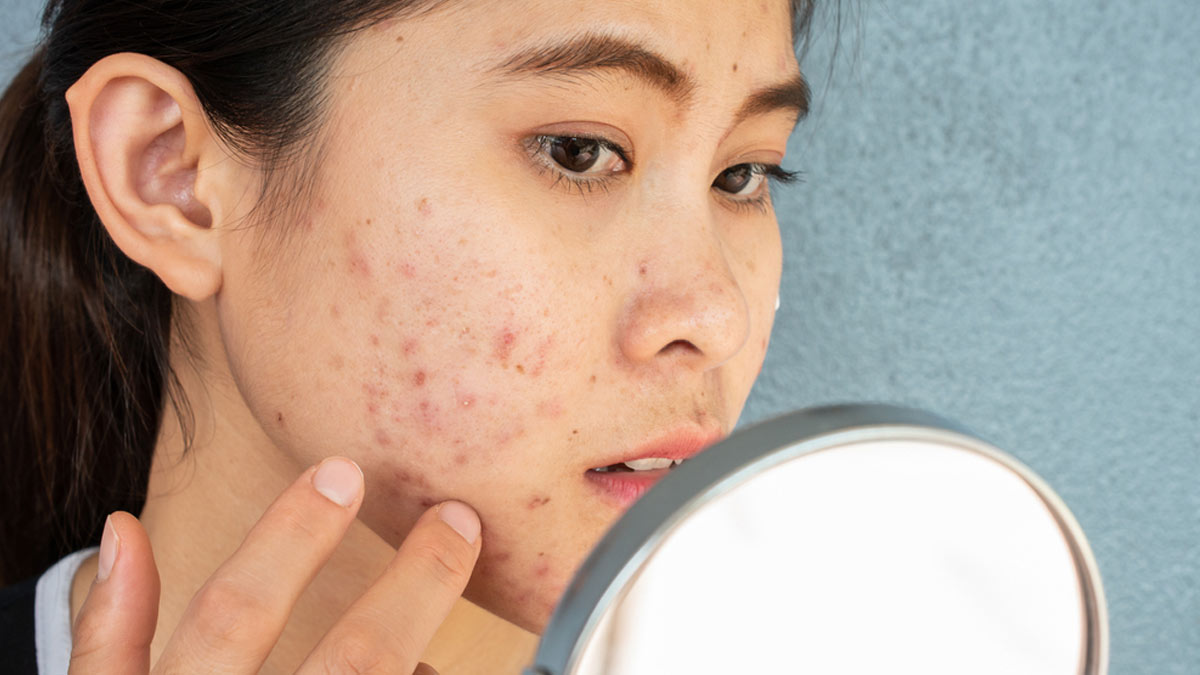 How Does A Low Glycemic Diet Help in Clearing Pimples & Acne